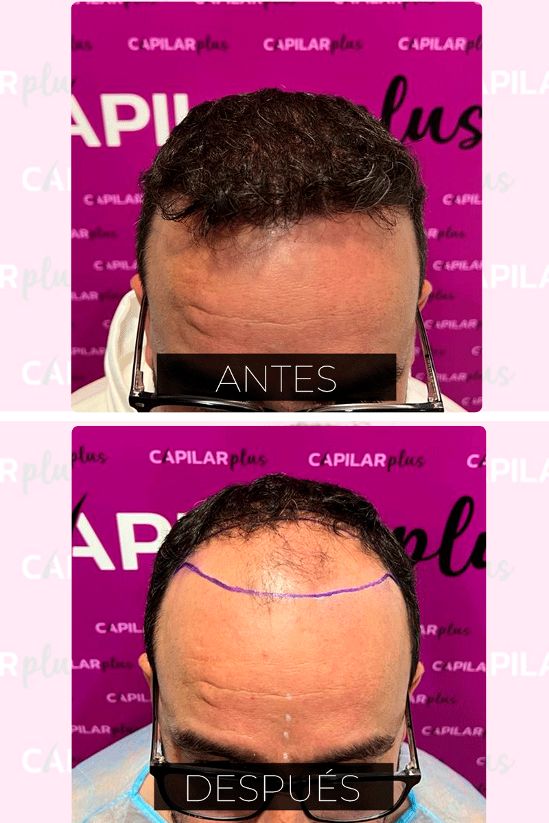CAPILAR PLUS INJERTO SEVILLA