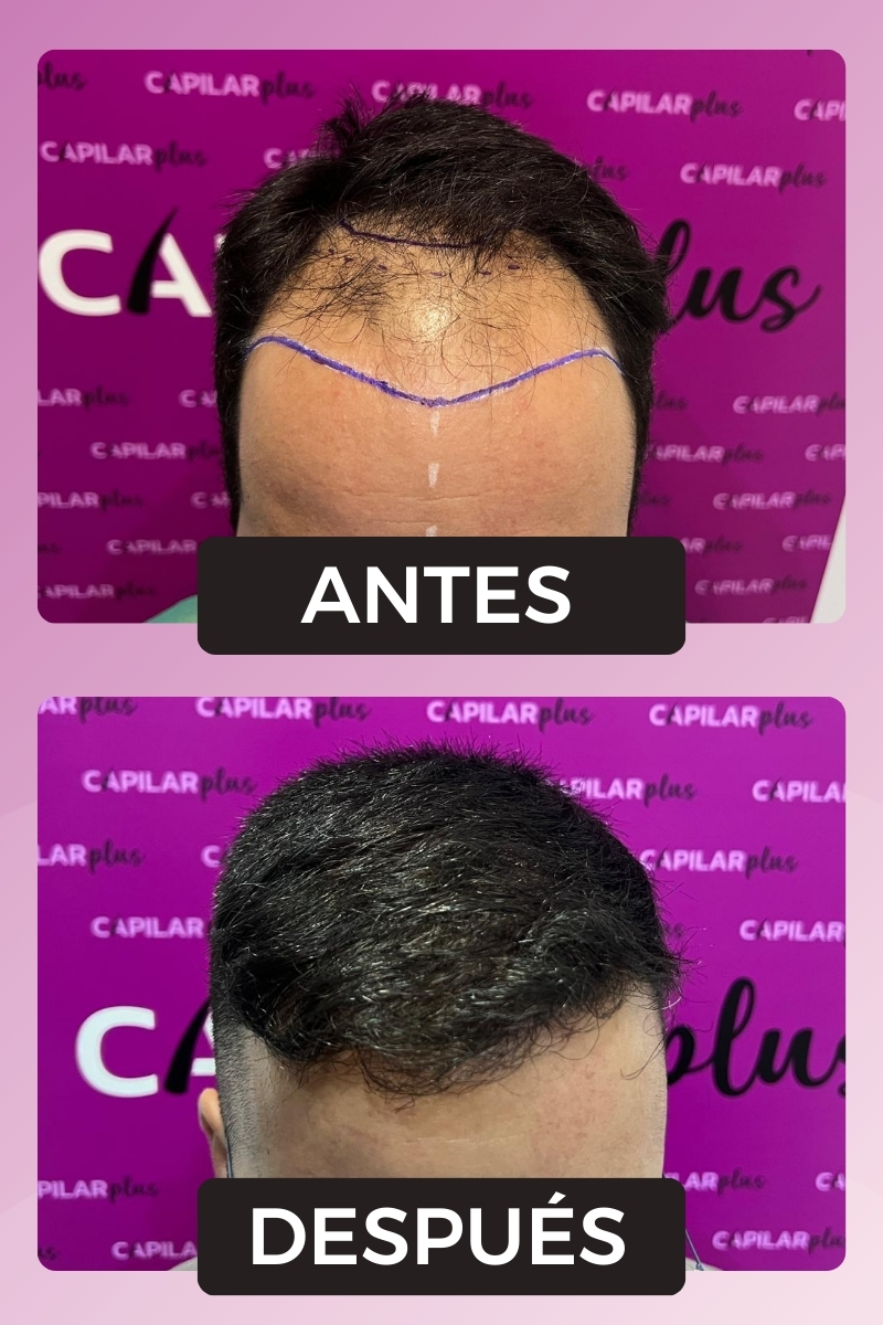 RESULTADOS INJERTO