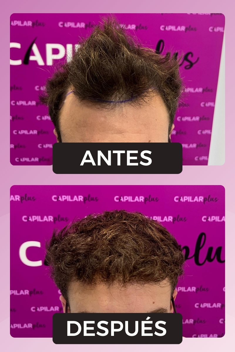 injerto capilar sevilla