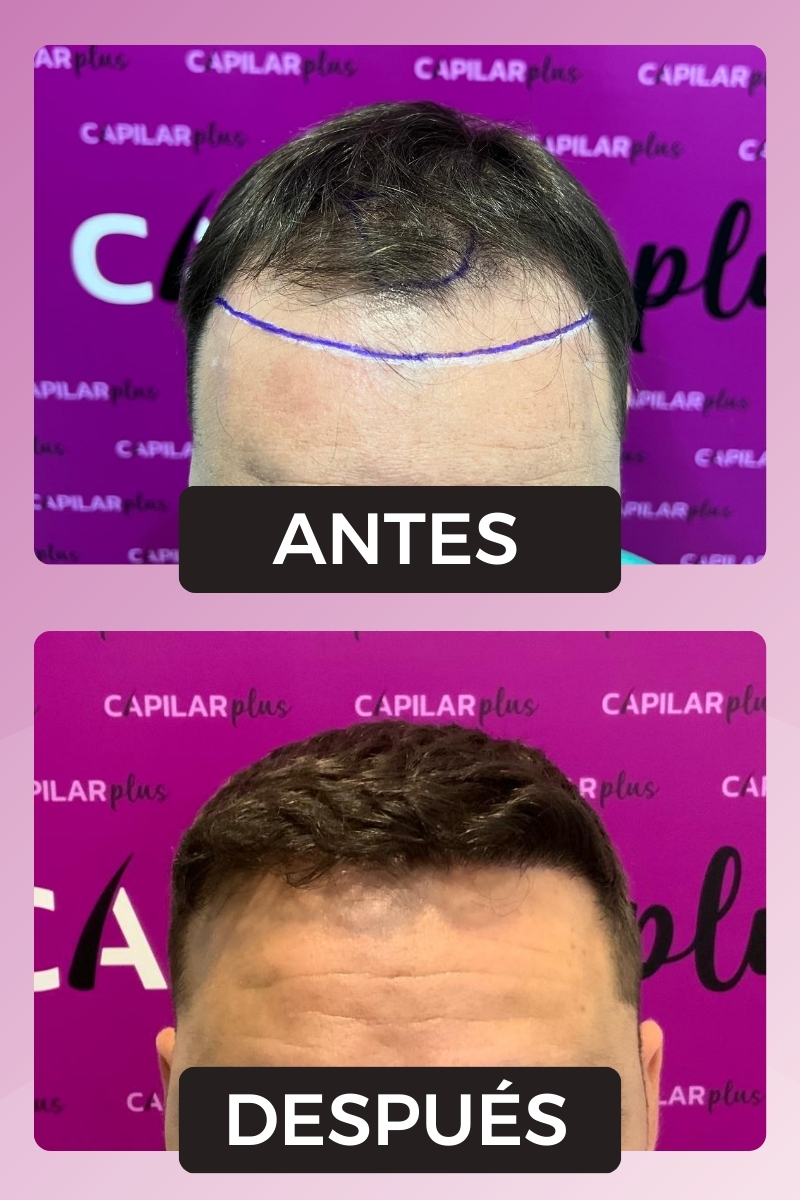 RESULTADOS INJERTO