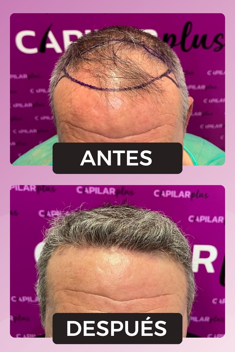 injerto capilar sevilla