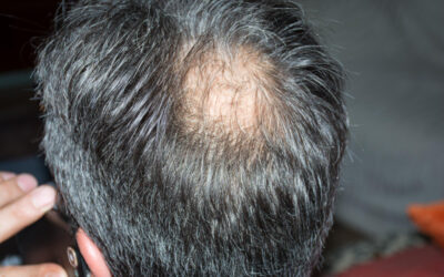 ¿Cómo combatir la alopecia areata?