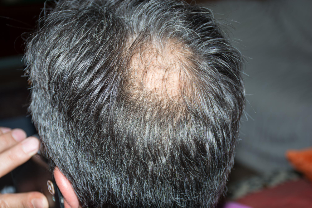 ¿Cómo combatir la alopecia areata?