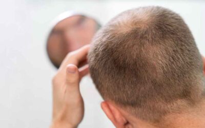 ¿La alopecia androgénica tiene cura?