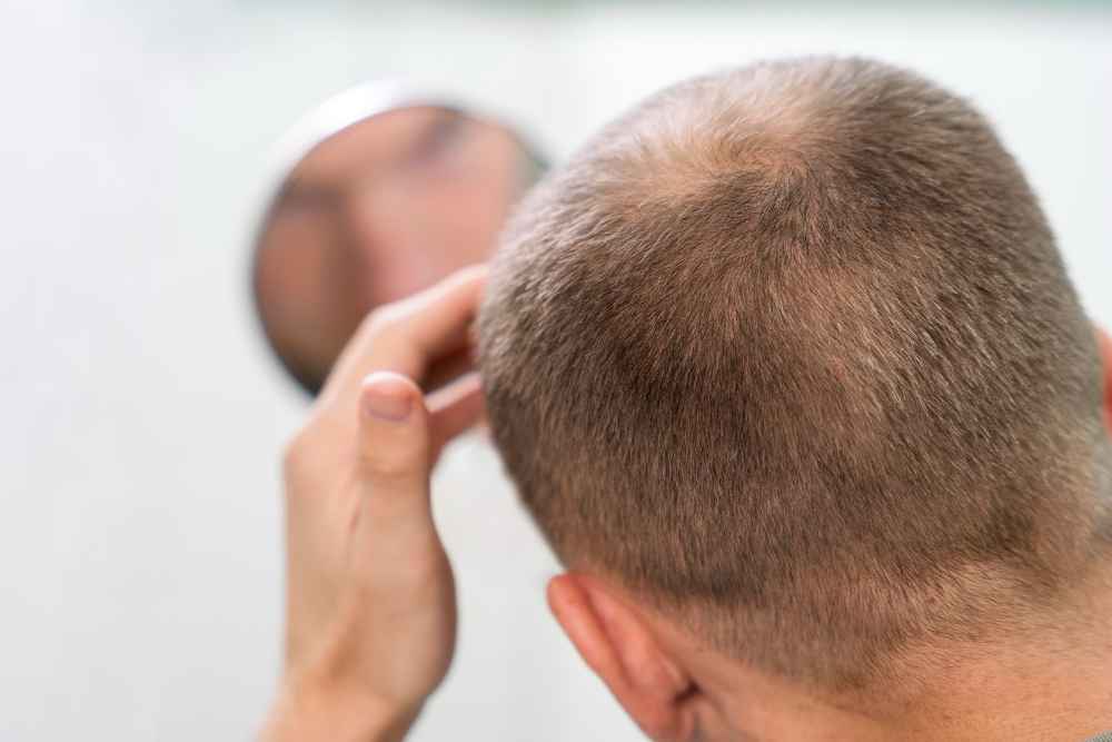 alopecia androgénica tiene cura