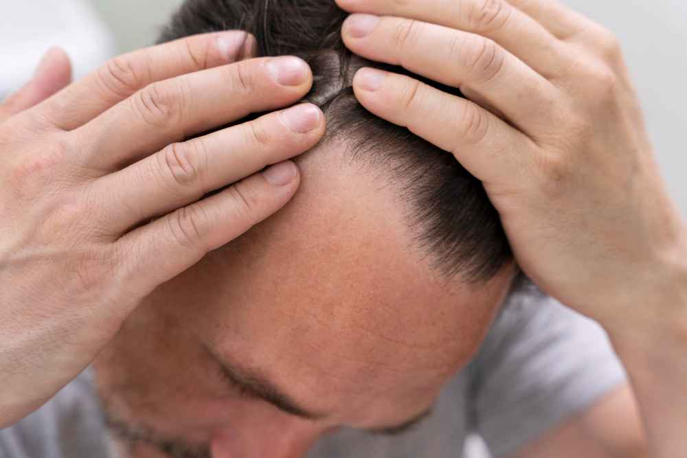 cuánto dura un trasplante de pelo