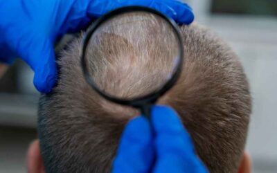 ¿De dónde se saca el pelo para el trasplante?