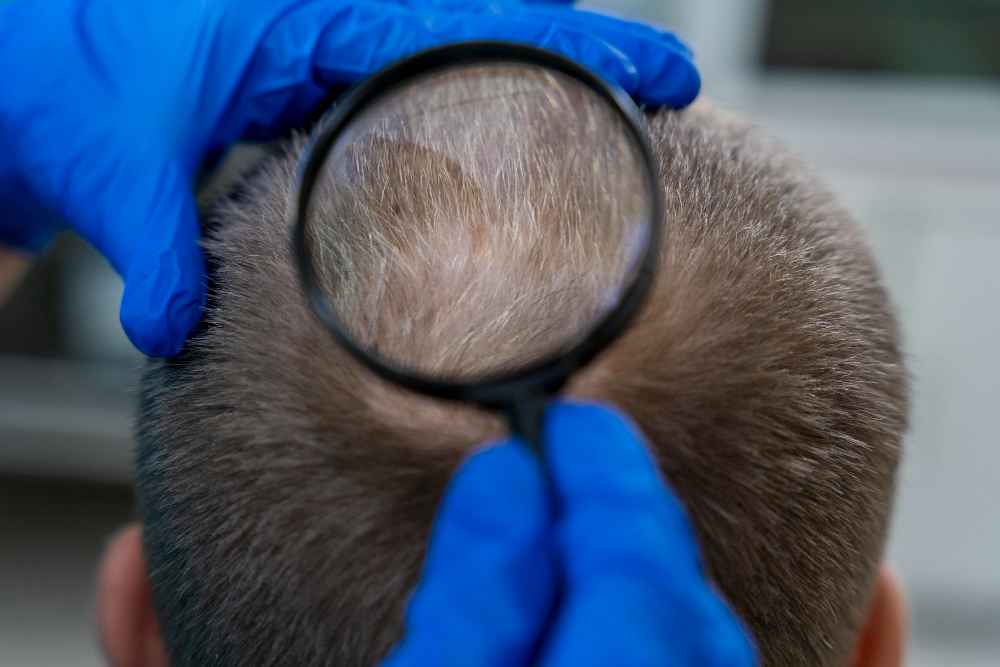 ¿De dónde se saca el pelo para el trasplante?