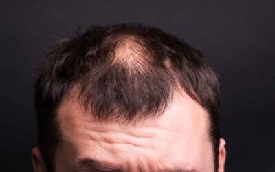 ¿Qué es y cómo se cura la foliculitis decalvante?