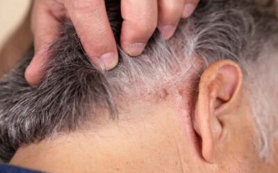 ¿La dermatitis seborreica provoca caída de pelo?