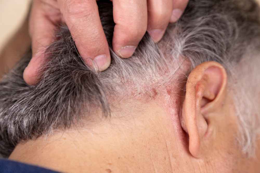 ¿La dermatitis seborreica provoca caída de pelo?