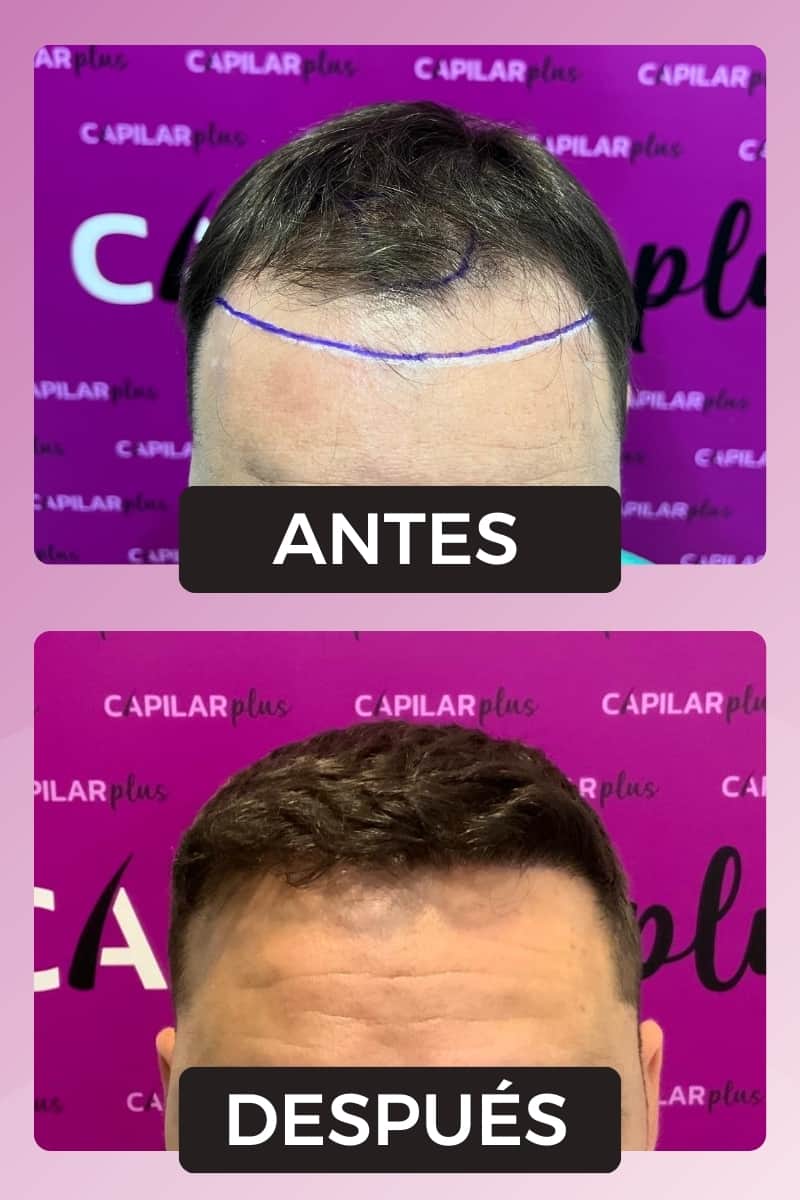 implante capilar sevilla 5