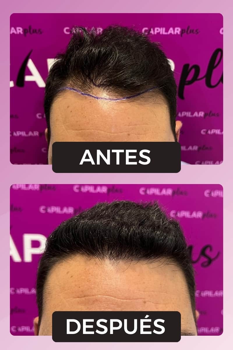 implante capilar 